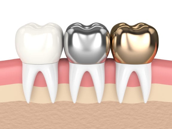 Computer model of different types of crowns