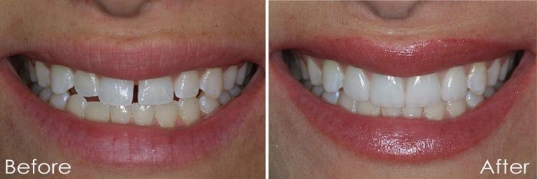 Before & After Smile